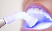 Ultrasonic cleaning of teeth from tartar