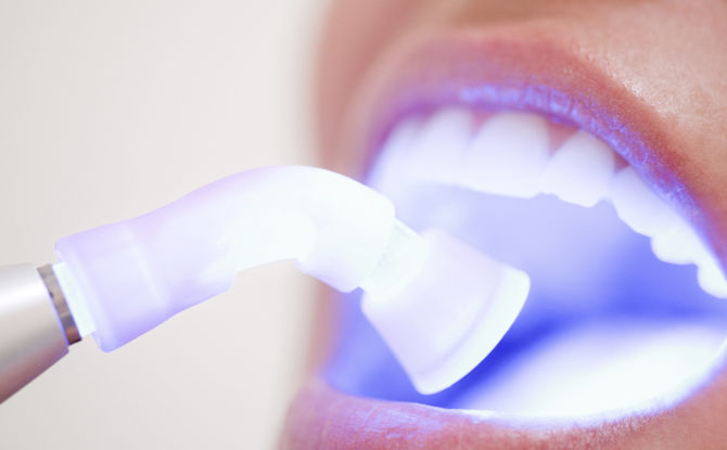 التنظيف بالموجات فوق الصوتية للأسنان من الجير