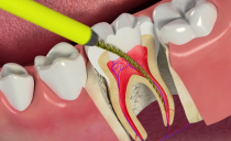 التهاب لب الأسنان: كيفية علاج وطرق ومراحل العلاج والمضاعفات والوقاية