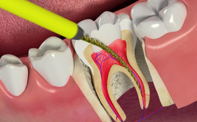 Tandpulpit: hur man botar, metoder och stadier i behandlingen, komplikationer, förebyggande