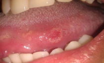 Syphilis in the mouth: ways of infection, signs and auxiliary symptoms, treatment