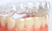 Chrániče zubů pro zarovnání zubů: co jsou a jak fungují