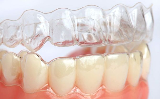 שומרי פה ליישור שיניים: מהם וכיצד הם עובדים