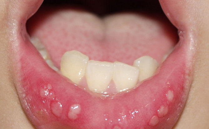 Cause dell'aspetto e del trattamento delle ulcere della bocca in un bambino