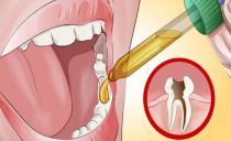 Bagaimana untuk merawat gigi yang rosak di rumah dan bagaimana untuk melegakan sakit gigi akut