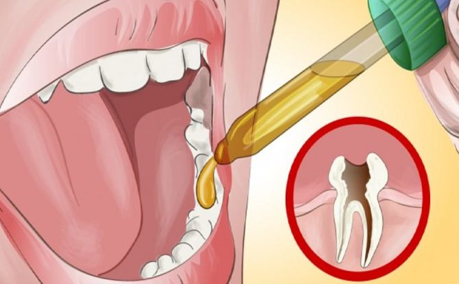 Hur man behandlar sjuka tänder hemma och hur man lindrar akut tandvärk