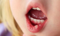 Herpes na boca em adultos e crianças: como fica e como tratar