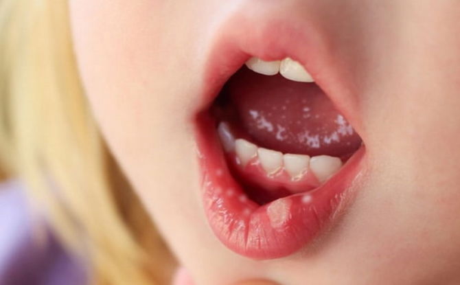 الهربس في الفم عند البالغين والأطفال: كيف يبدو وكيف يعالجون