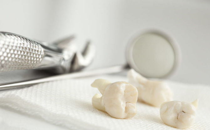 Krvarenje nakon vađenja zuba: razlozi za zaustavljanje kod kuće