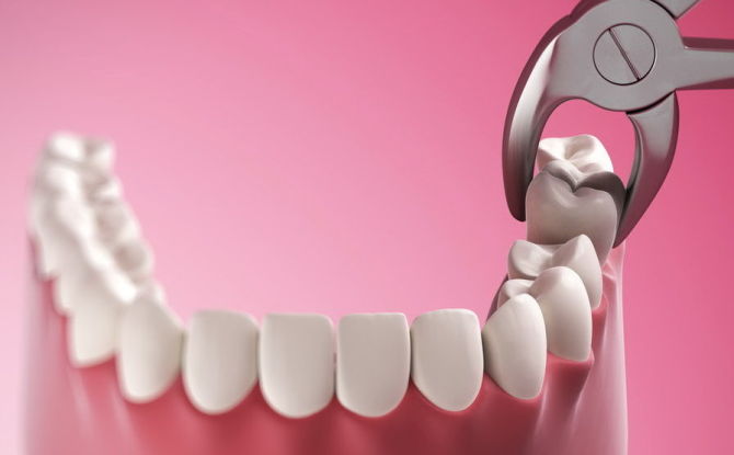 Kann man während der Schwangerschaft Zähne entfernen, wie erfolgt die Entfernung?