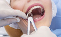 Extracción de la raíz de un diente con caries o caries: duele, el proceso de extracción