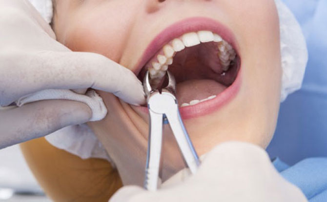 Extracción de la raíz de un diente con caries o caries: duele, el proceso de extracción