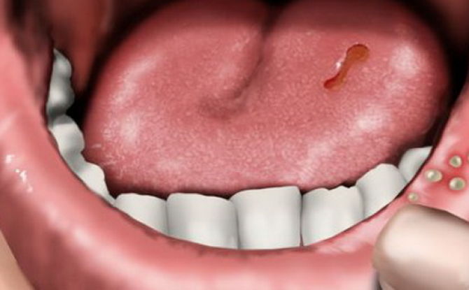 Stomatite dans la bouche chez l'adulte: si cela se produit, comment et avec quoi traiter