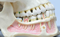 التهاب العظم والنقي في الفك السفلي والعلوي: الأسباب والأعراض والعلاج
