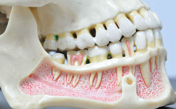 التهاب العظم والنقي في الفك السفلي والعلوي: الأسباب والأعراض والعلاج