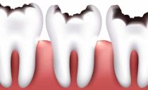 Classificazione della carie dentale secondo il sistema Black e WHO, in particolare la preparazione delle cavità