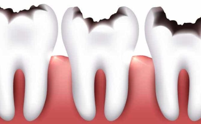 Klasifikácia zubného kazu podľa systému Black a WHO, najmä príprava dutín