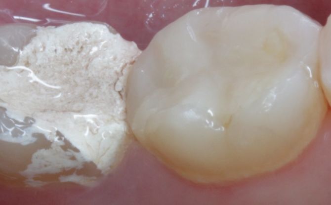 Arzén v zubu: proč to uvádějí, kolik dospělých a dětí mohou držet, jak to funguje, možné komplikace