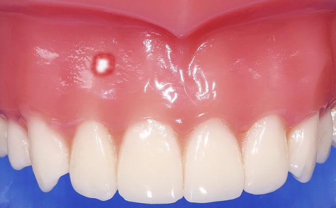 Weiße Wunde am Zahnfleisch: Ursachen, Behandlung, Foto