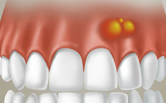 Proč se na dásni vytváří hrudka a jak se jí zbavit
