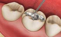 Types of dental fillings: which are, which are better to put