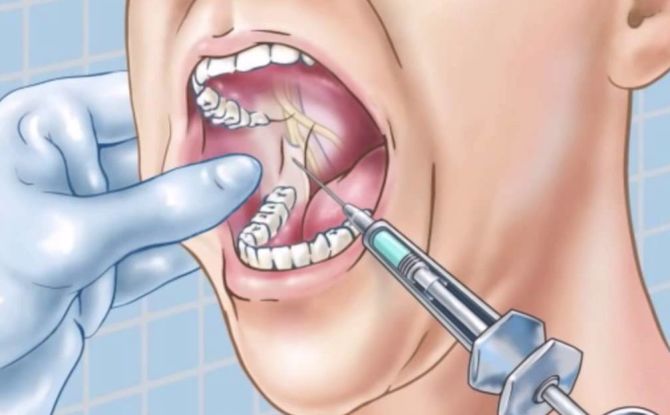 Провеждаща анестезия в стоматологията - какво е това, видове