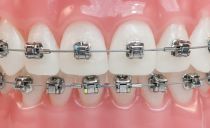 Kolik výztuh je třeba nosit, aby se zuby zarovnaly, jak jsou výztuhy nasazeny