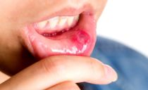 Hur och hur man snabbt bota stomatit i munnen hos vuxna hemma