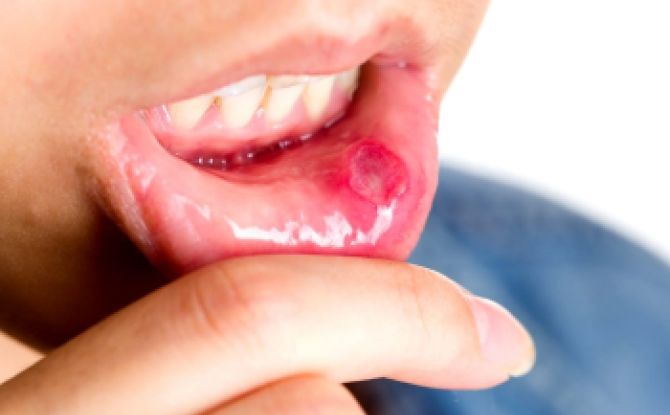 Wie und wie man Stomatitis im Mund bei Erwachsenen zu Hause schnell heilt