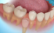 Regeneración de nuevos dientes jóvenes en humanos: tecnología y práctica.