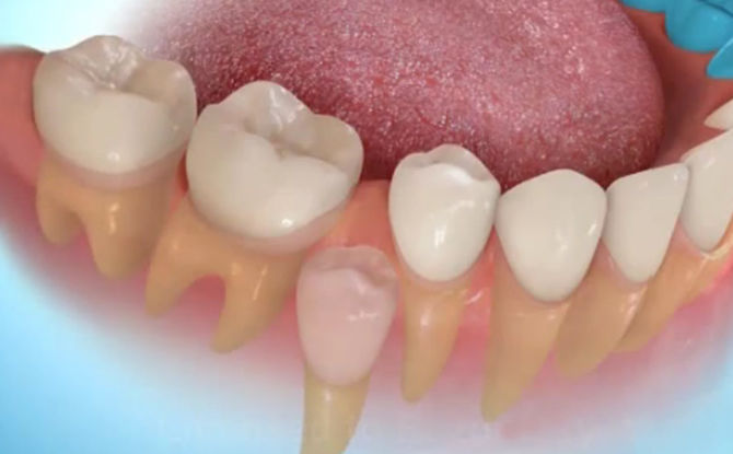 Régénération de nouvelles jeunes dents chez l'homme: technologie et pratique