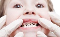 Răng bạc ở trẻ em: tại sao cần thiết, chỉ định, phương pháp mạ bạc của răng nguyên thủy