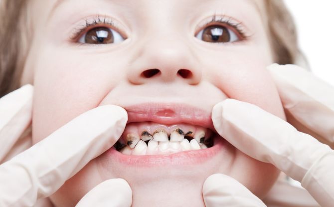 Mengasah gigi pada kanak-kanak: mengapa perlu, petunjuk, kaedah perak gigi utama
