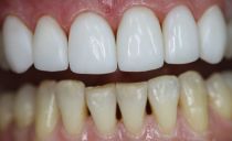 Métodos e etapas da restauração artística e estética dos dentes da frente