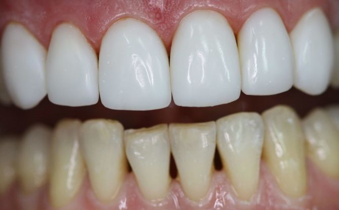 Methods and stages of artistic and aesthetic restoration of front teeth