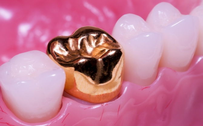 Jenis-jenis mahkota pada gigi, yang mana mahkota paling baik ditempatkan di hadapan dan gigi mengunyah