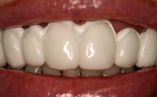 Dantų emalio pakartotinis pritaikymas odontologijoje ir namuose