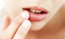 Ointments, creams and gels for cold sores on the lips: a list of effective medicines for cold sores