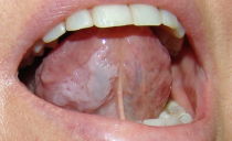 Leucoplasie de la muqueuse buccale et de la langue: formes, causes, symptômes, traitement