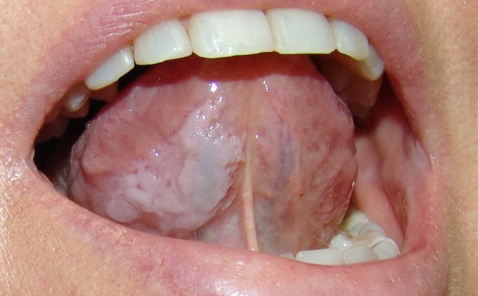 Leukoplakija oralne sluznice i jezika: oblici, uzroci, simptomi, liječenje