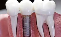 Metodi e fasi di installazione di impianti dentali, indicazioni, controindicazioni, durata dell'operazione e termini di attecchimento