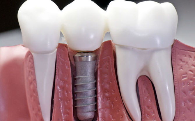 Kaedah dan peringkat pemasangan implan gigi, petunjuk, kontraindikasi, tempoh operasi dan terma engraftment