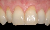 Eksponering av tennens hals: årsaker og behandling