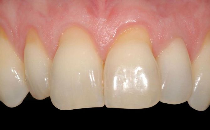 Expunerea gâtului dintelui: cauze și tratament