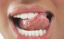 Kviser på tungen: årsaker og behandlingsmetoder