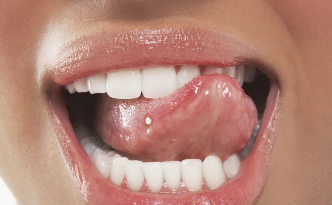 Spuogai ant liežuvio: gydymo priežastys ir metodai