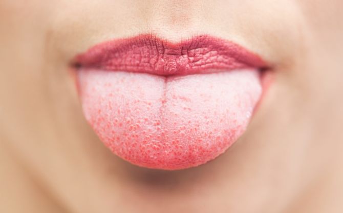 Červené pupienky na jazyku: aké nebezpečné to je a ako ho liečiť
