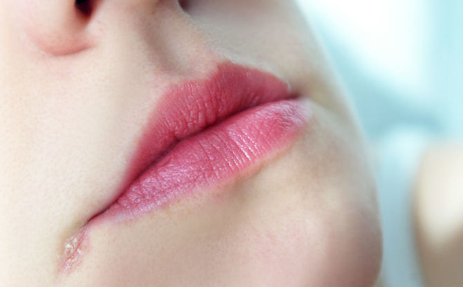 Lèvres dans les coins des lèvres: causes et traitement