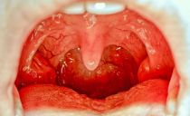 Infiammazione delle tonsille e delle tonsille nella gola negli adulti e nei bambini: sintomi, cause, trattamento, foto