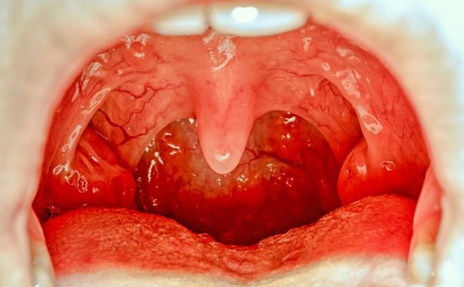 Inflamarea amigdalelor și amigdalelor la gât la adulți și copii: simptome, cauze, tratament, fotografie